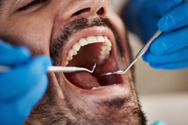 Best Emergency Dentist for Knocked-Out Tooth in West Livingston, TX